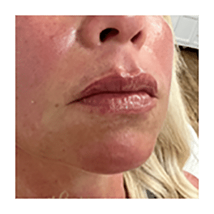 Lip Filler