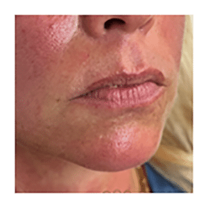 Lip Filler