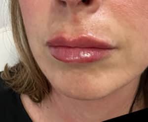 Lip Filler