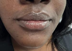 Lip Balancing with Filler