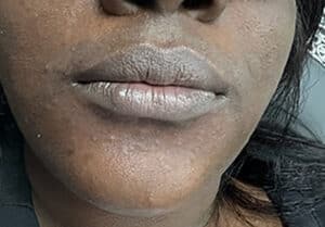 Lip Balancing with Filler